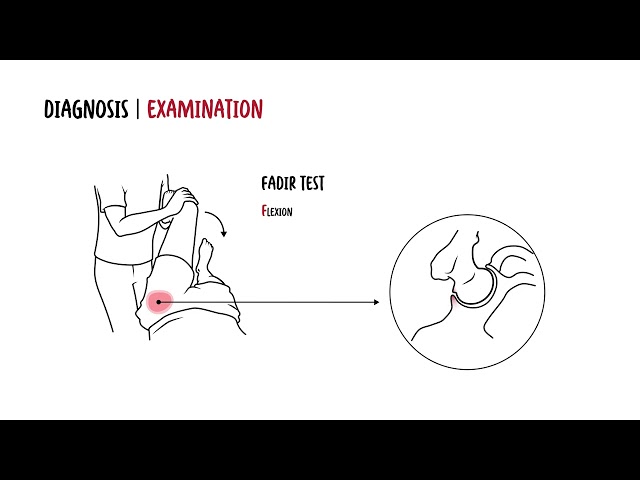 Femoroacetabular Impingement Explained: Groin Pain, Labral Tears, Best Exercises & Surgery