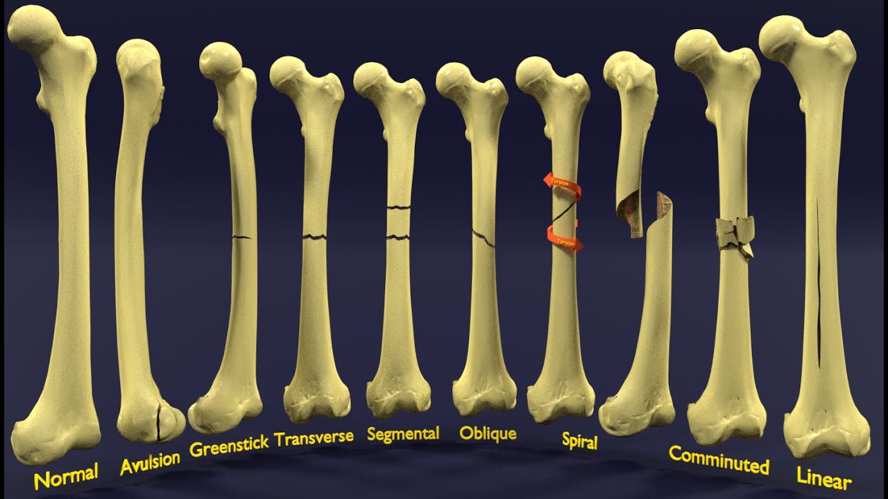 Fracture types labelled 3D Model