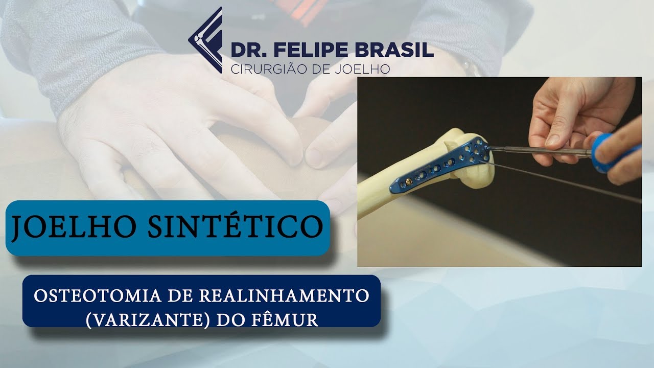 OSTEOTOMIA VARIZANTE (REALINHAMENTO) DO FÊMUR - WORKSHOP