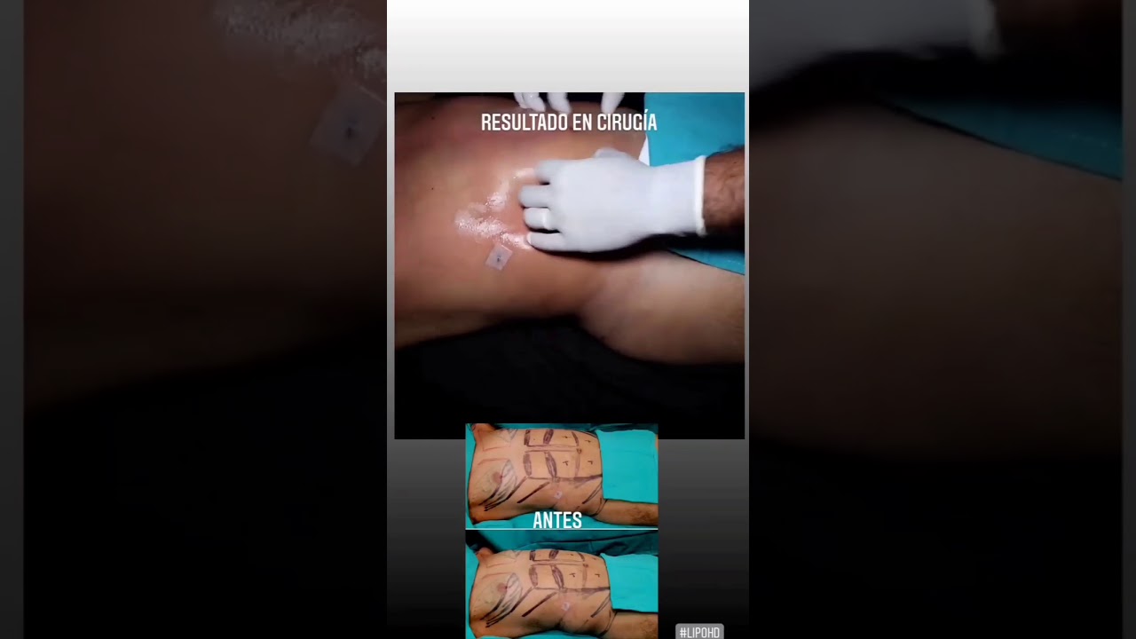 Watch Lipoescultura láser hd alta definición o lipo hd desde el antes al después en cirugia Now Lipoescultura láser hd alta definición o lipo hd desde el antes al después en cirugia