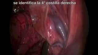 Hiperhidrosis palmar bilateral: simpatectomia toracoscópica