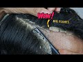 Itchy Dry Scalp Big Dandruff Scratching 1185