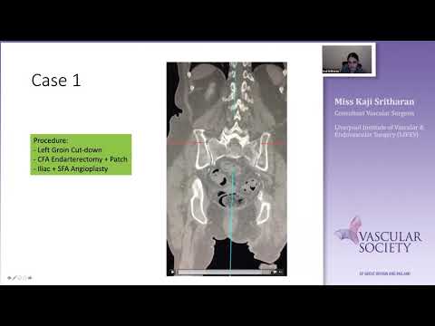 Iliac intervention: How I do it