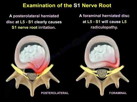 Comparative Evaluation of S1 vs. L5 Nerve Root: Motor, Sensory, and Reflex Analysis.