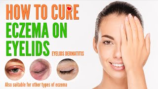 How to cure eczema on eyelids | Eyelids Dermatitis treatment and natural home remedies 2021