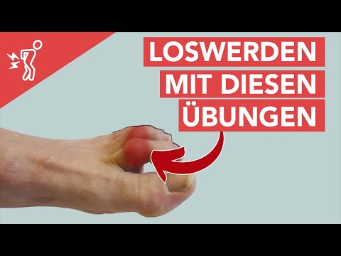 3 effektive Krallenzehen Übungen (und Hammerzehen)│ SanoGym