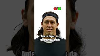 Famosos antes e depois da harmonização facial #antesedepois #famosos #fofoca #harmonizacaofacial