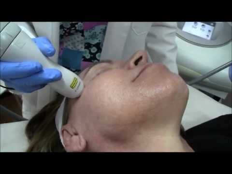 Skin Care in Miami using Fractional Laser at MD Ageless Solutions