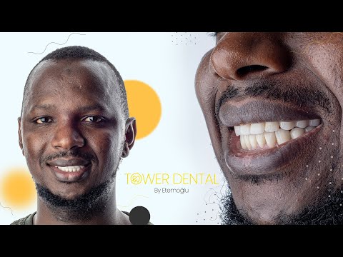 From Belgium to Tower Dental Clinic: 26 Zirconia Crowns & 2 Implants