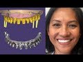 The Most Difficult Full Mouth Implant Case | Part 1