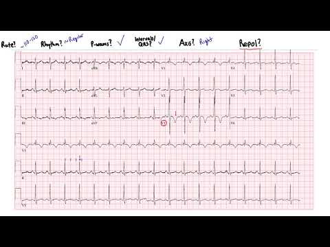 Perfect PE ECG