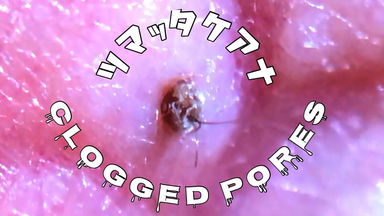 No.20 肩にできた角栓を抜く！remove the keratin plug on the shoulder.