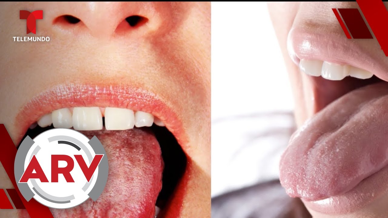 La lengua color blanco podría anunciar 4 posibles enfermedades | Al Rojo Vivo | Telemundo