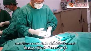 ผ่าตัดดึงหน้าท้องเฉพาะบางส่วน ผ่าตัดดึงหน้าท้องเฉพาะบางส่วน