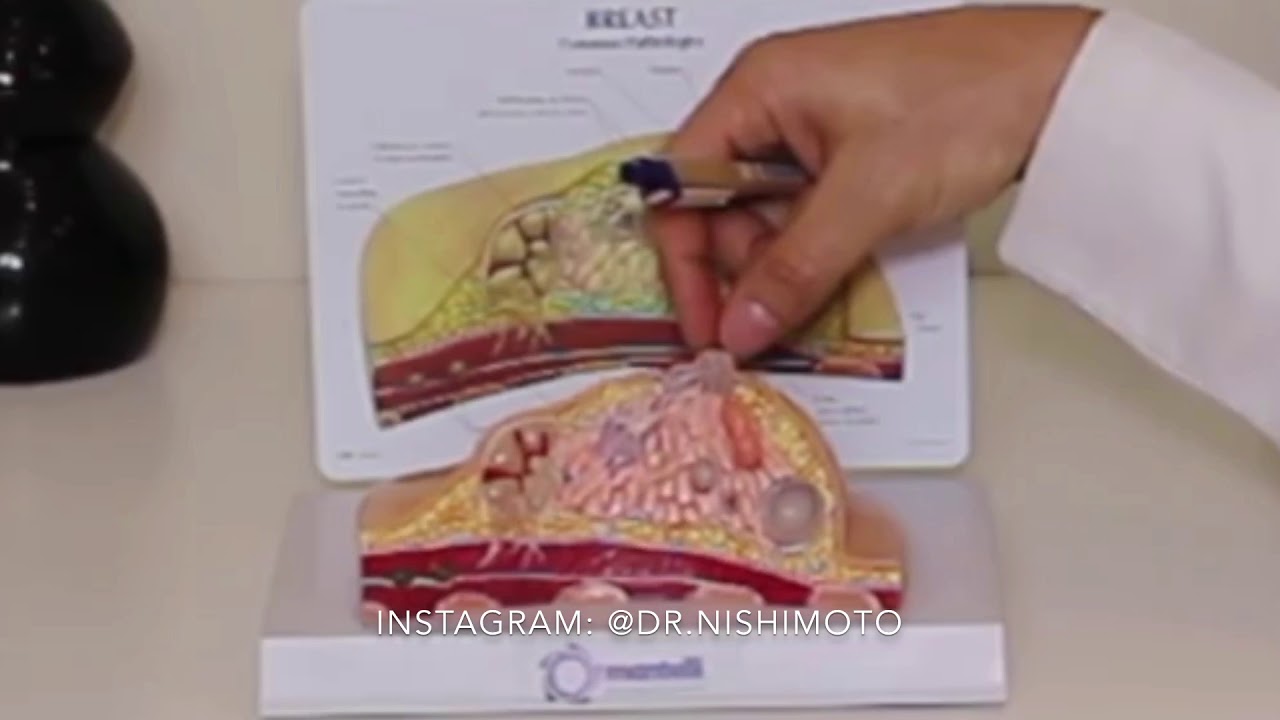 Correção Cirúrgica Do Mamilo Invertido