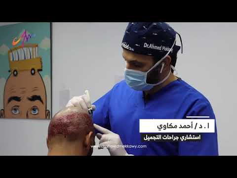 مرحلة الرسم من أهم المراحل فى عملية زراعة الشعر الطبيعي