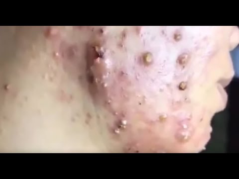 BESTПРЫЩ КОВЫРЯЕМ ЖИРНЫЕ ПРЫЩИ И ЧЕРНЫЕ ТОЧКИ