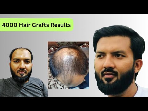 Hair Transplant in Mumbai | Amazing Hair Transplant...