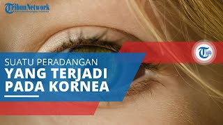 Keratitis, Suatu Peradangan atau Inflamasi yang Terjadi pada Kornea Mata