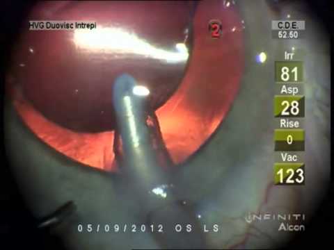 Neuhann Anterior CCC Optic Capture for Posterior Capsule Tear