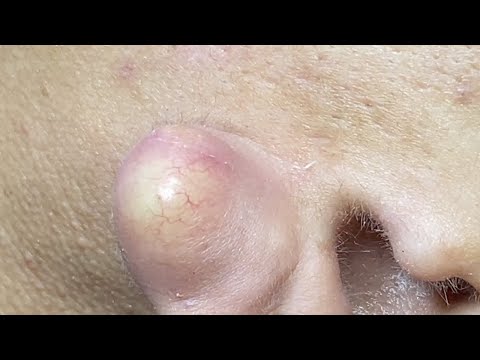 Epic Cyst Popping on the Ear