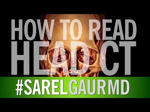 How to read Head CT:  Diagnosing Acute Stroke / Infarct