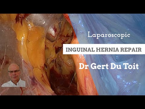 Laparoscopic Inguinal hernia repair