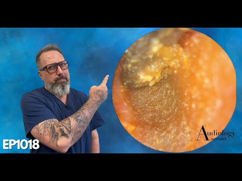 FUDGY EAR WAX REMOVAL USING JOBSON HORNE -EP1018