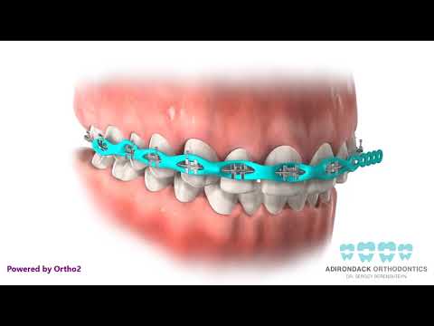 Closing Spaces   Power Chain