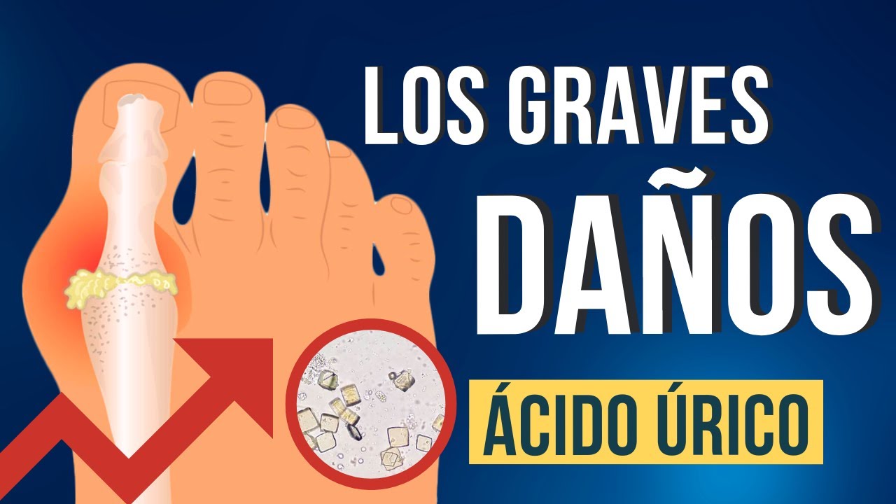 Dolores articulares por ácido úrico. Causas, síntomas y tratamiento