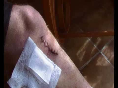 comment soigner ascite