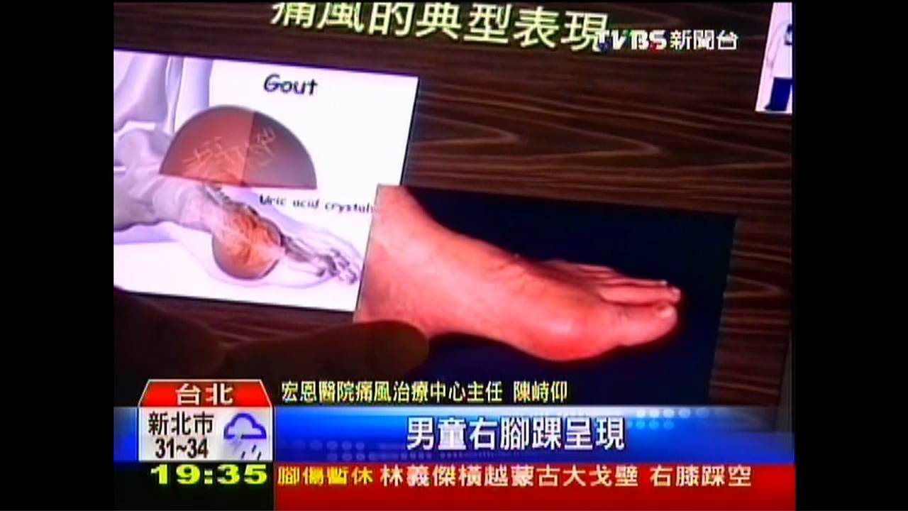 天天4碗滷肉飯 8歲男童痛風跛行