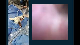 Core Videos (2024): Cystoscopy with Retrograde Pyelogram and Ureteral Stent Placement