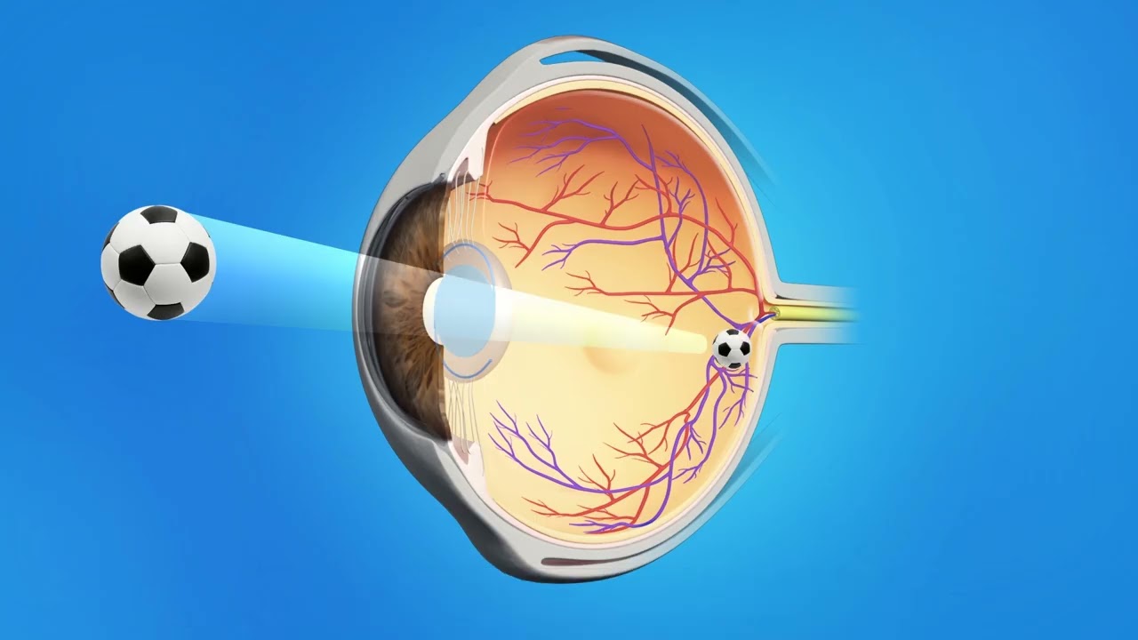 Cataract Phaco with Monofocal Lens