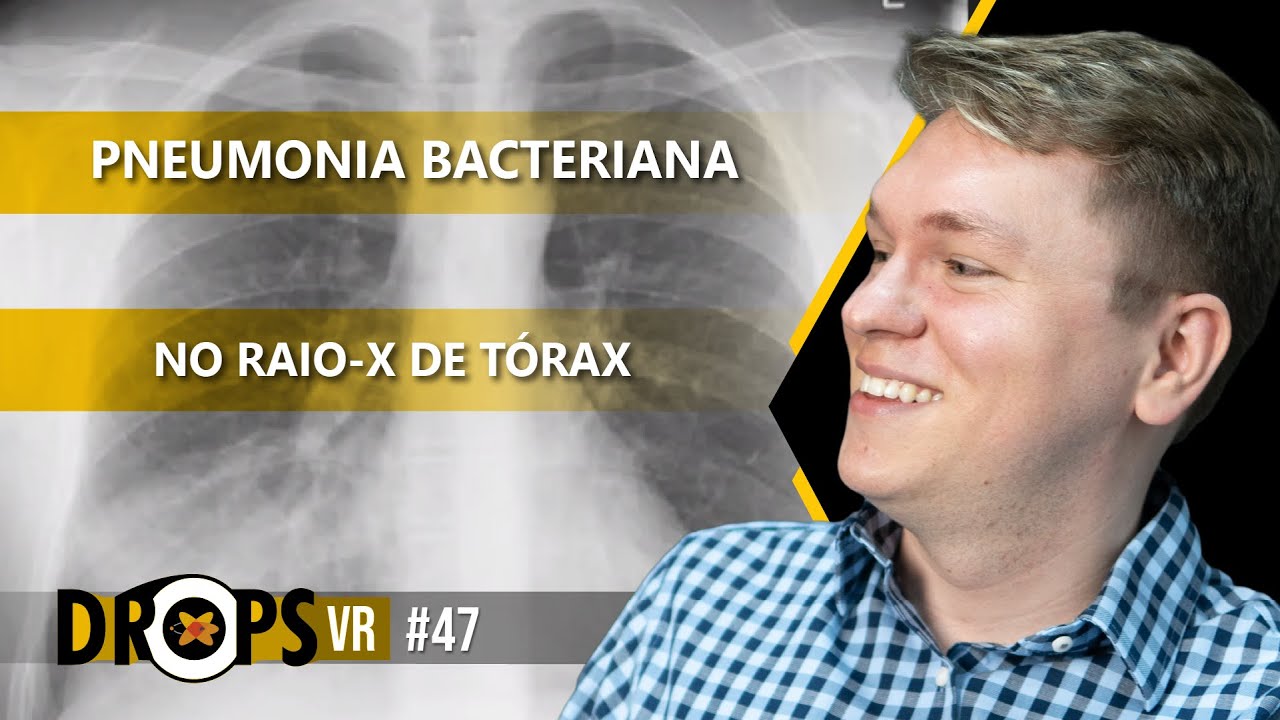 APRENDA COMO IDENTIFICAR A PNEUMONIA BACTERIANA NO RAIO X DE TÓRAX I VOCÊ RADIOLOGISTA
