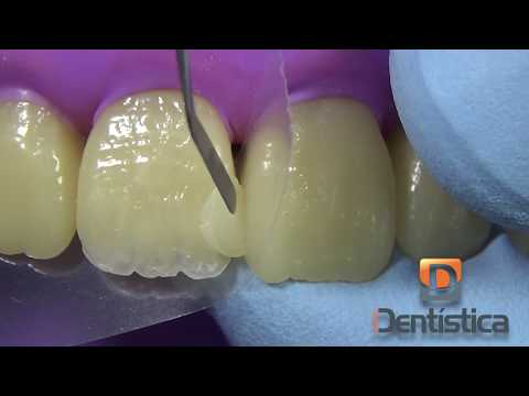 Restauração de dente anterior fraturado