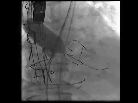 BAV of the Aortic Valve Showing the Watermelon Seeding of the Balloon