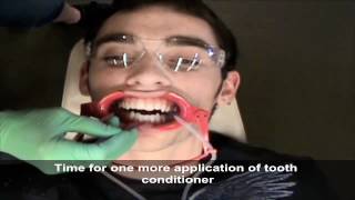 Braces Austin | How Ortho 360 Can Install Braces in Under 15 Minutes