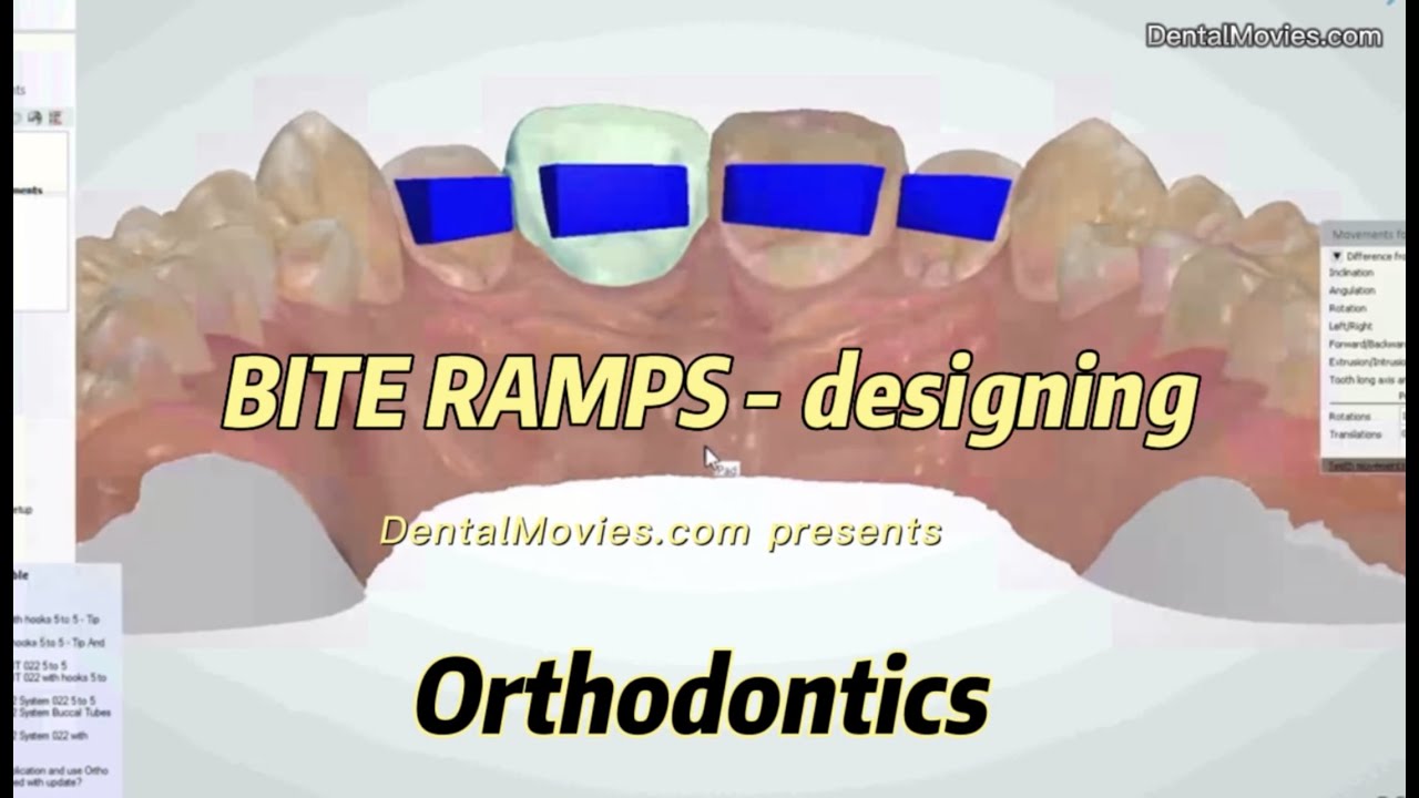 BITE RAMPS - designing 🕹📐🔎🦷