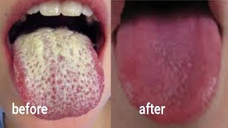 EASY AND NATURAL WAY TO CLEAN DIRTY TONGUE AND REMOVE BAD BREATH