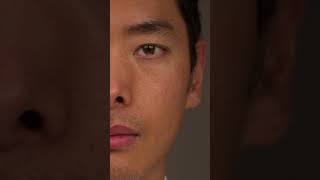 Bleeding inside the eye for 30 days. #Shorts