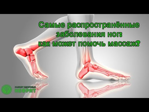 Primo soccorso per fratture delle articolazioni Lagente più efficace per osteocondrosi cervicale