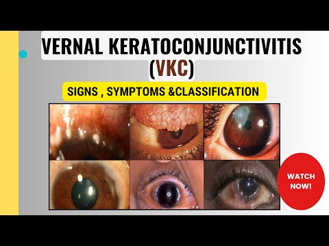 VKC | Frühlingskeratokonjunktivitis | Frühlingskatarrh