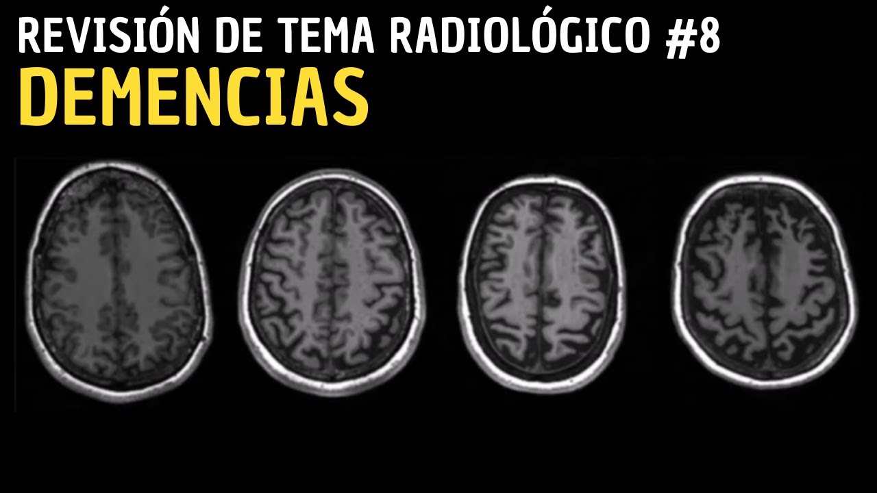 Revisión de Tema 8: Demencias.