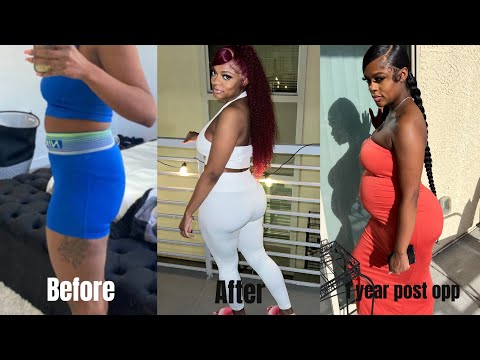 Skinny BBL 1 Year Post Op UPDATE | Weight Gain, Regrets, Pregnancies