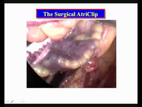 James L  Cox. Closure of the la appendage - should we be more aggressive?