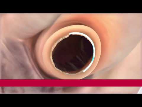 A Perceval Plus IMPLANT video