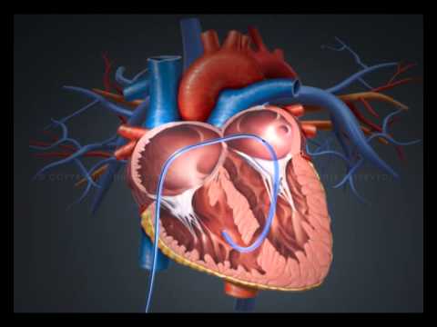 Tran-septal approach for clousure of muscular VSD in small children