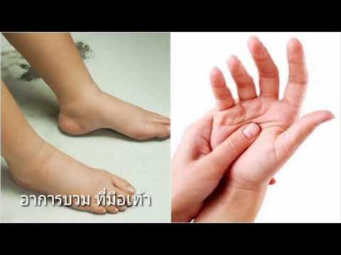 อาการของโรคสะเก็ดเงิน ครีมดาวเรืองกลากในมือ