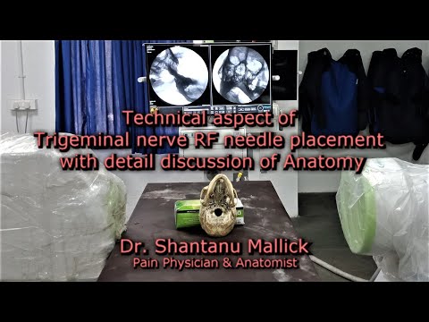 Technical aspect of Trigeminal Nerve RF needle placement by Dr. Shantanu Mallick